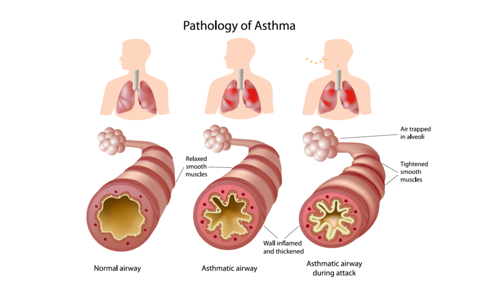 8 Steps to Avoid Asthma Flare