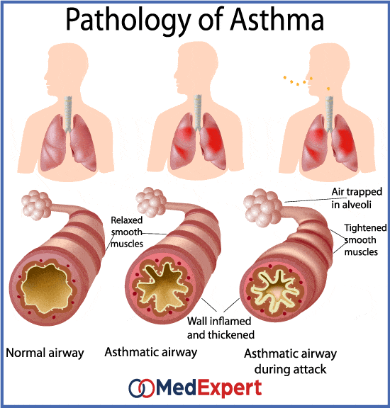 Allergic asthma treatment, symptoms and diagnosis