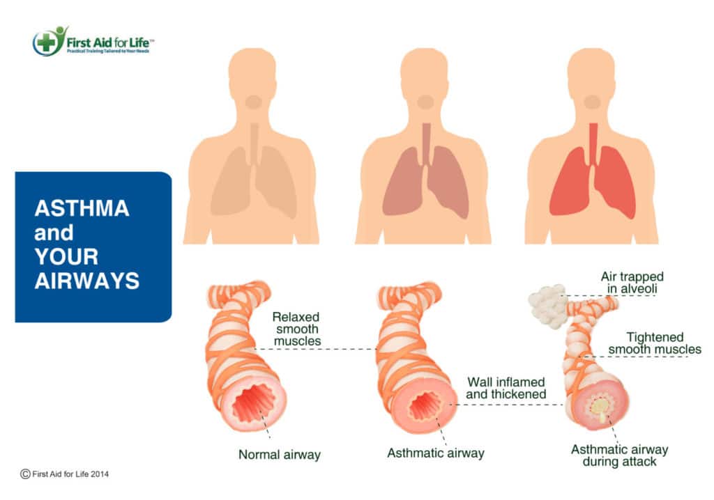 Asthma â what it is and how to help if someone is having ...