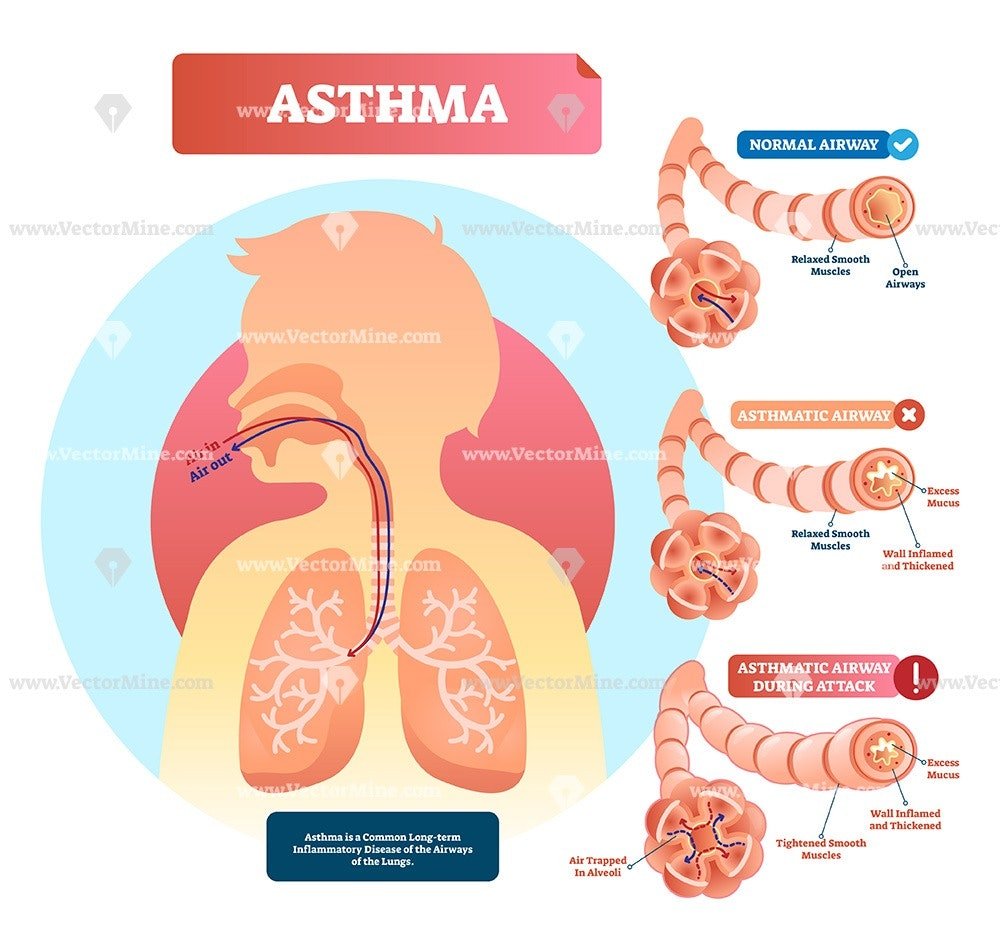 Asthma anatomical vector illustration infographic diagram