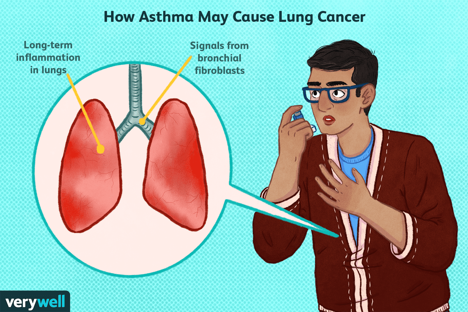 Asthma as a Possible Cause of Lung Cancer