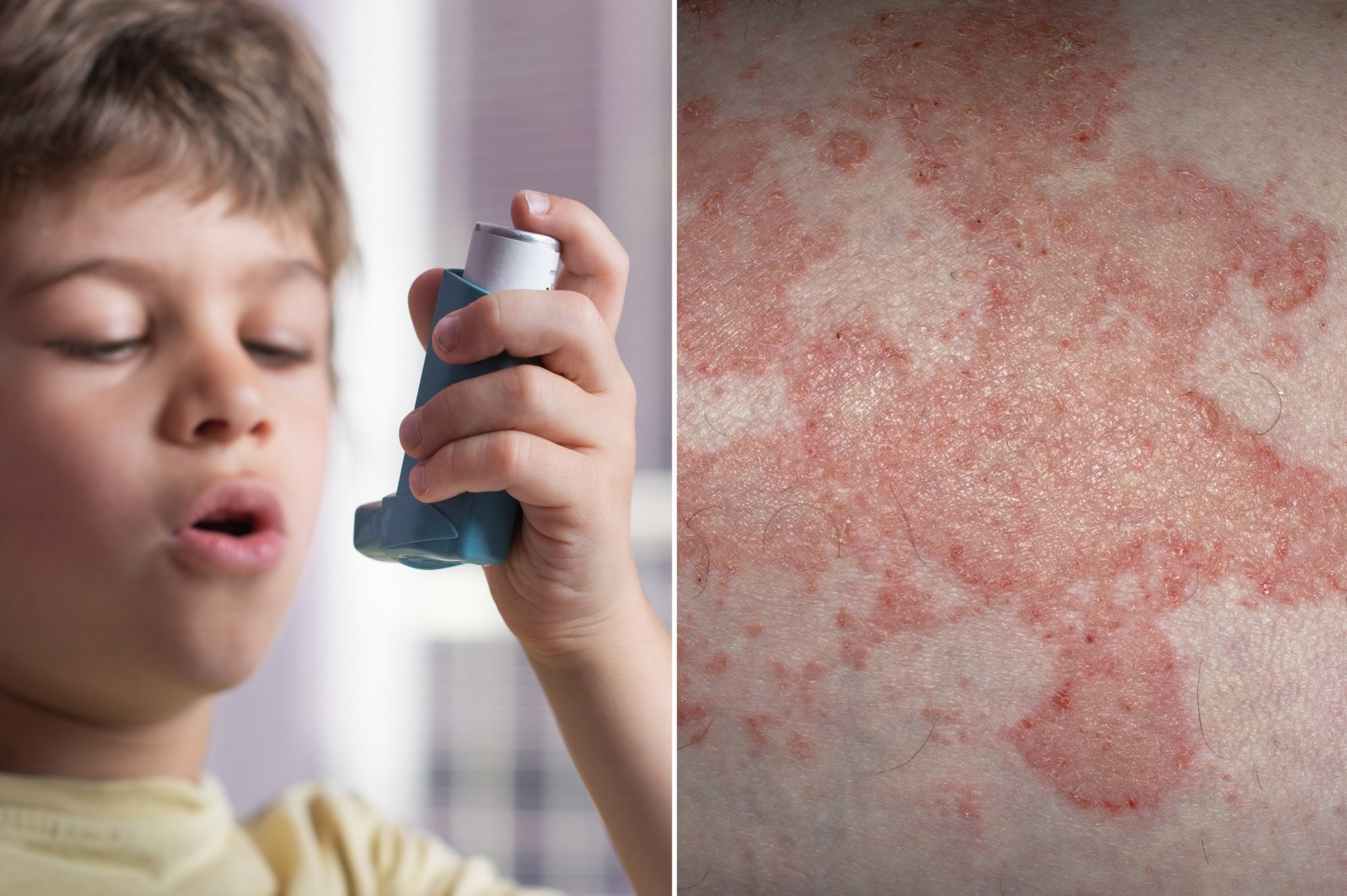Asthma, Atopic Dermatitis May Predispose to Behavioral and ...