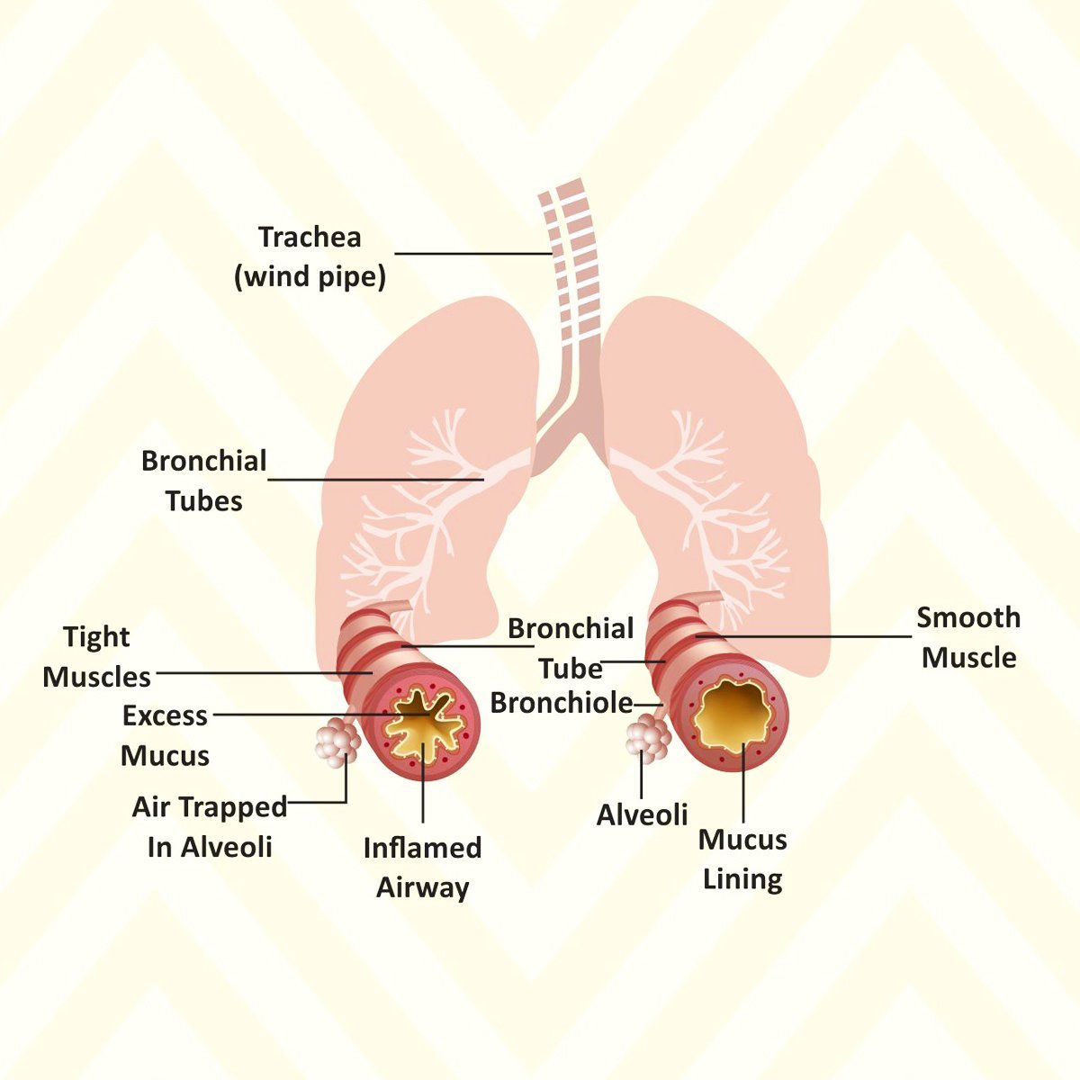 Asthma Attack in Children: Causes, Early Warning Signs ...