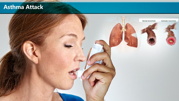 Asthma Attacks â Causes, Early Warning Signs, and Quick ...
