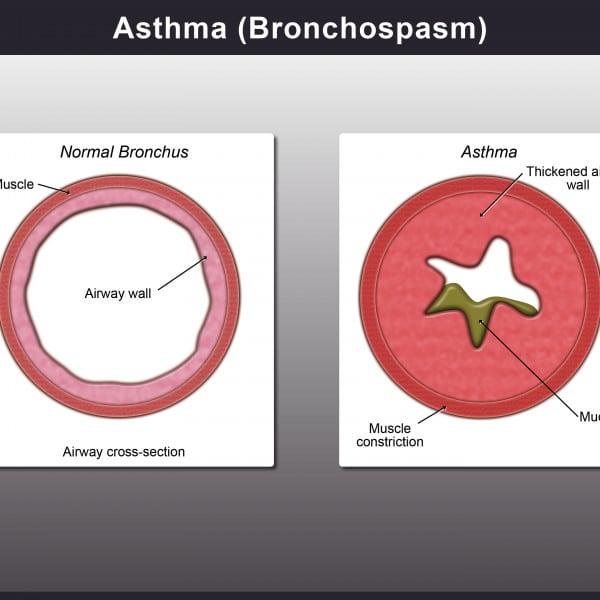 Asthma (Bronchospasm)