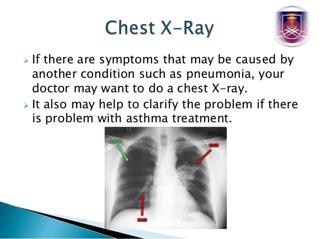 Asthma Can Cause Chest Pain