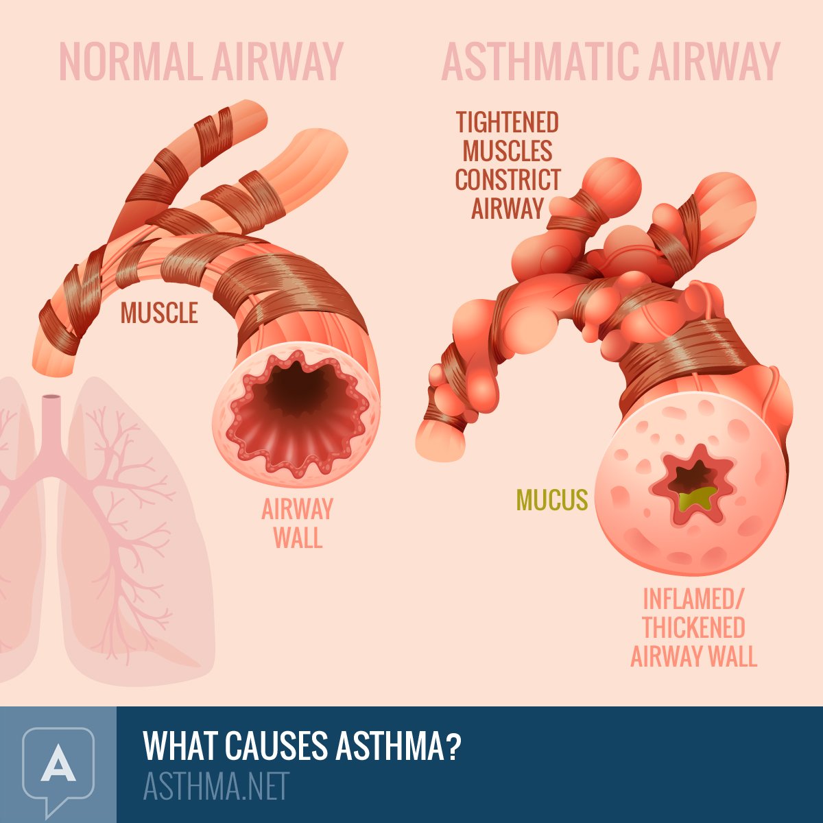Asthma Causes Of