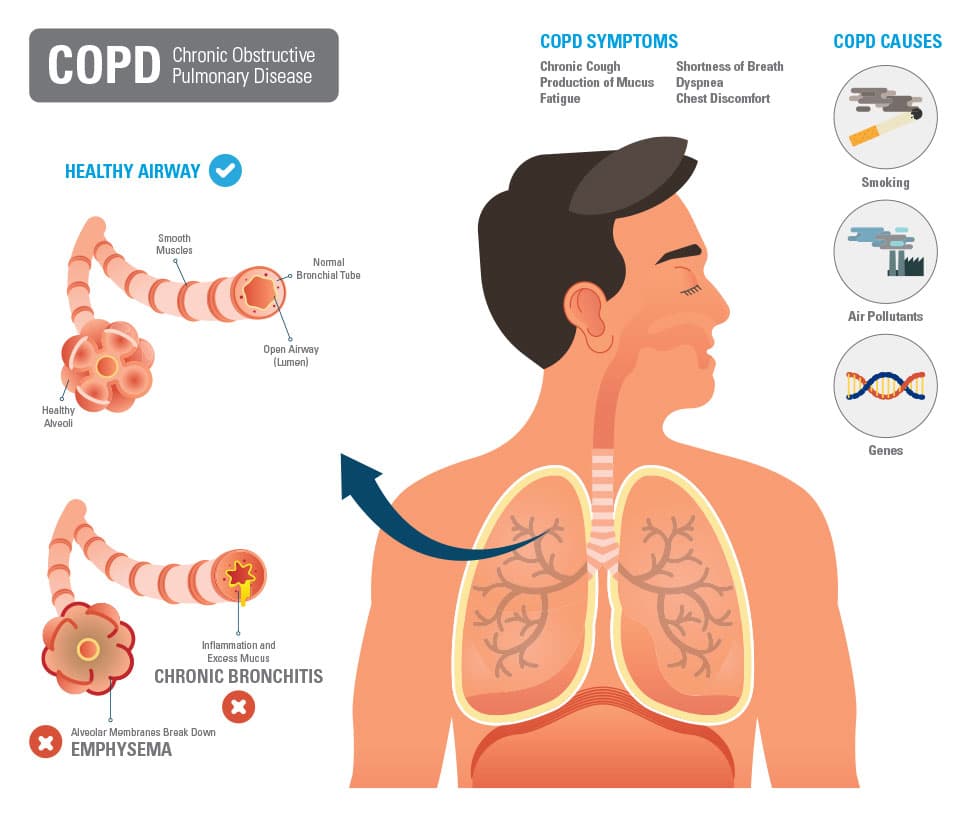 Asthma &  COPD