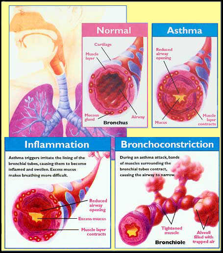 Asthma Effect On Respiratory System