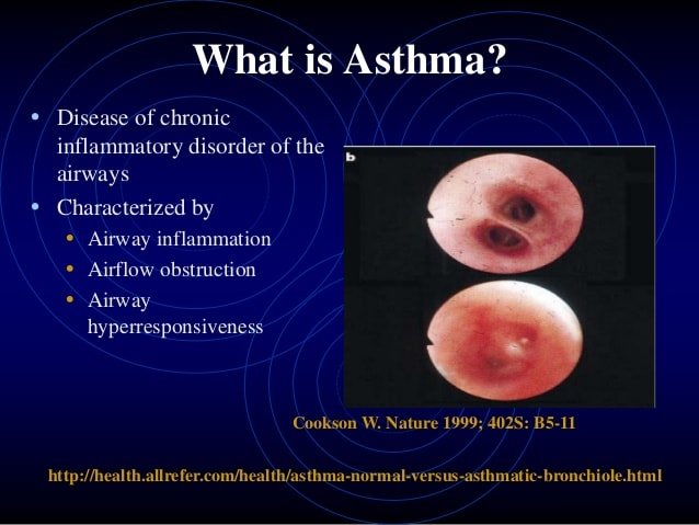 Asthma in children 2014