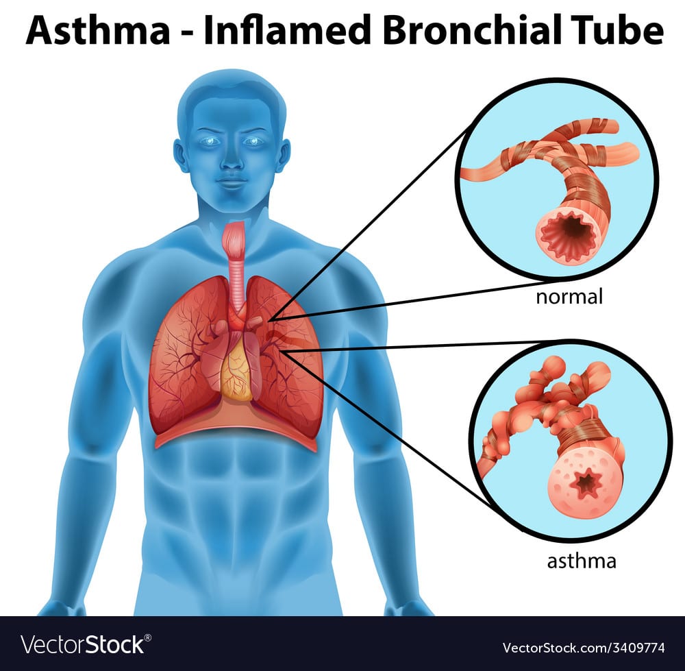 Asthma Inflamed Bronchial Tube