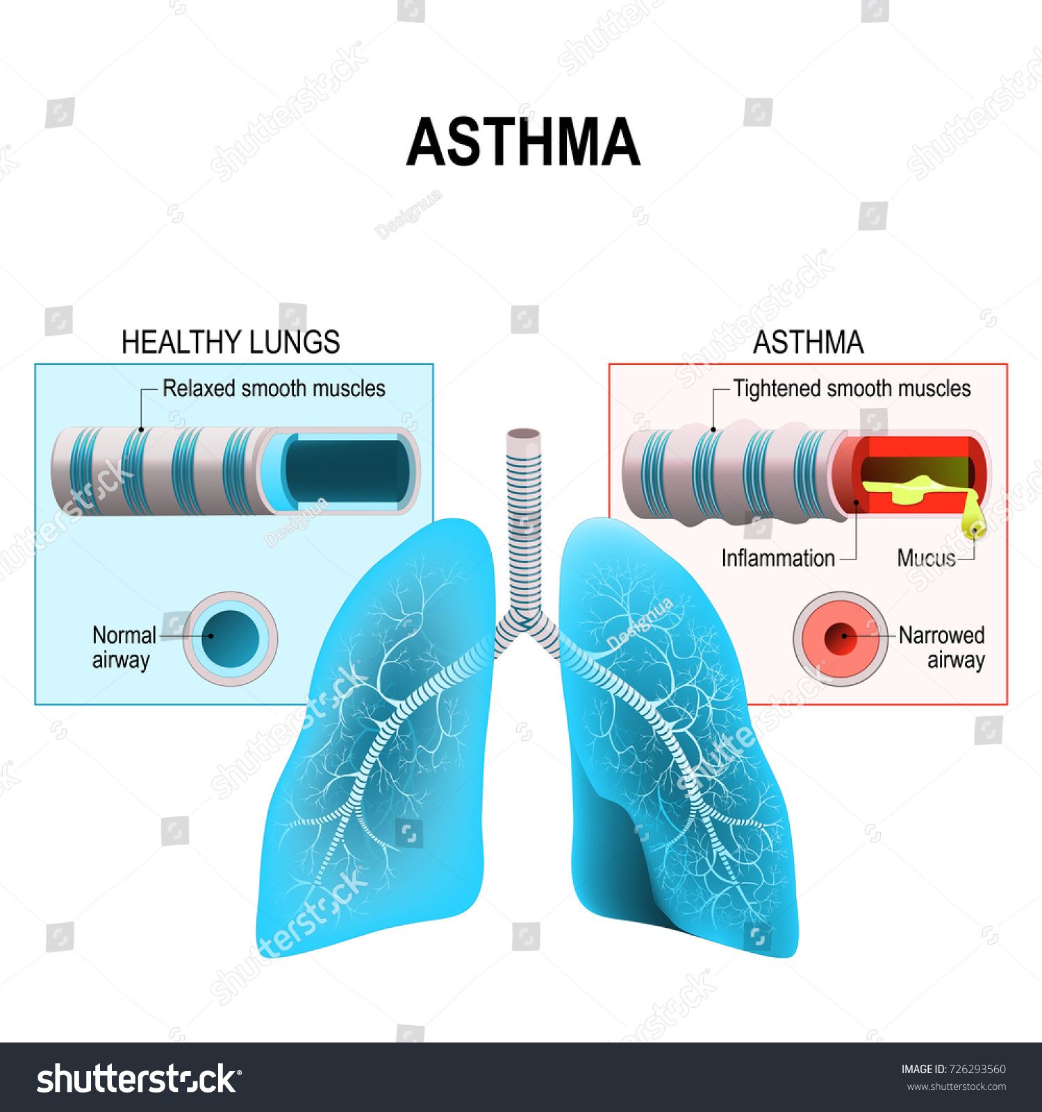 Asthma is a chronic inflammatory disease of the airways ...