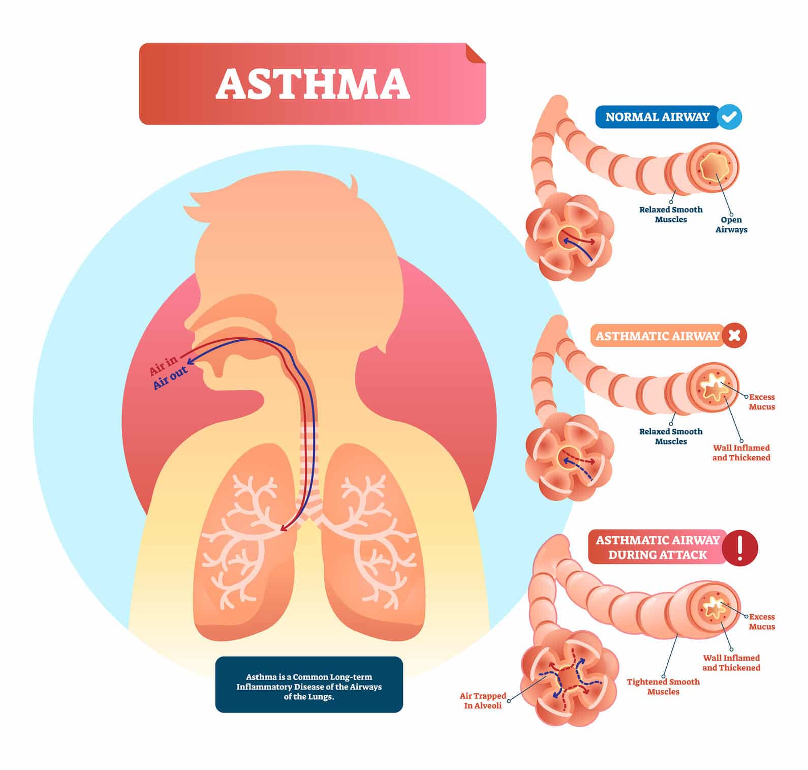 Asthma: Is It a Reversible Disease?