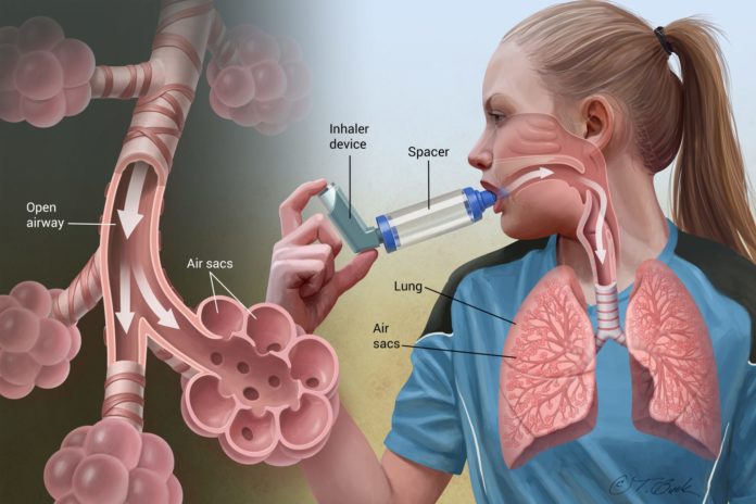 ASTHMA OVERVIEW
