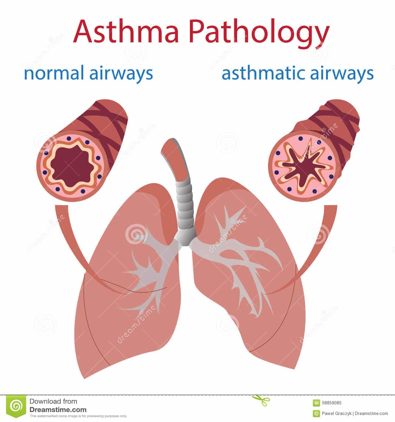 Asthma Pathology Stock Vector