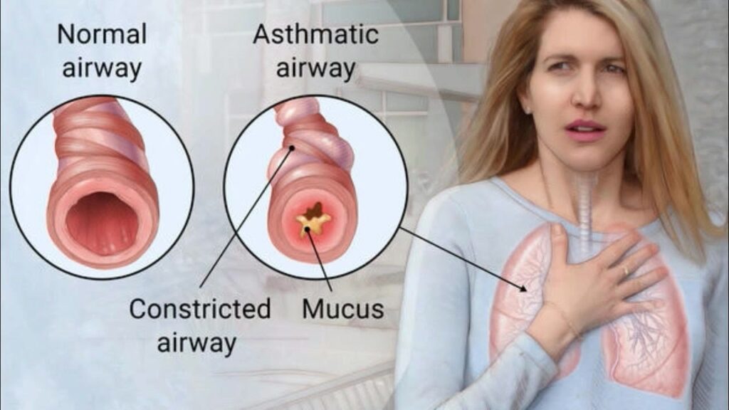 Asthma Symptoms, Causes, Medication, Treatment » SignSymptom