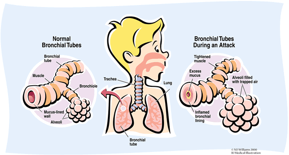 Childhood bronchial asthma: acute exacerbation diagnosis and treatment ...