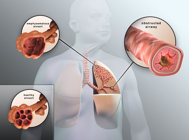 COPD Symptoms and Stages