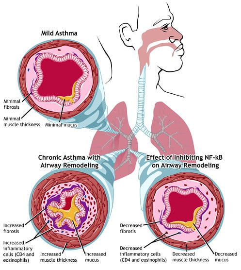 Difference Between Acute and Chronic Asthma Exacerbation