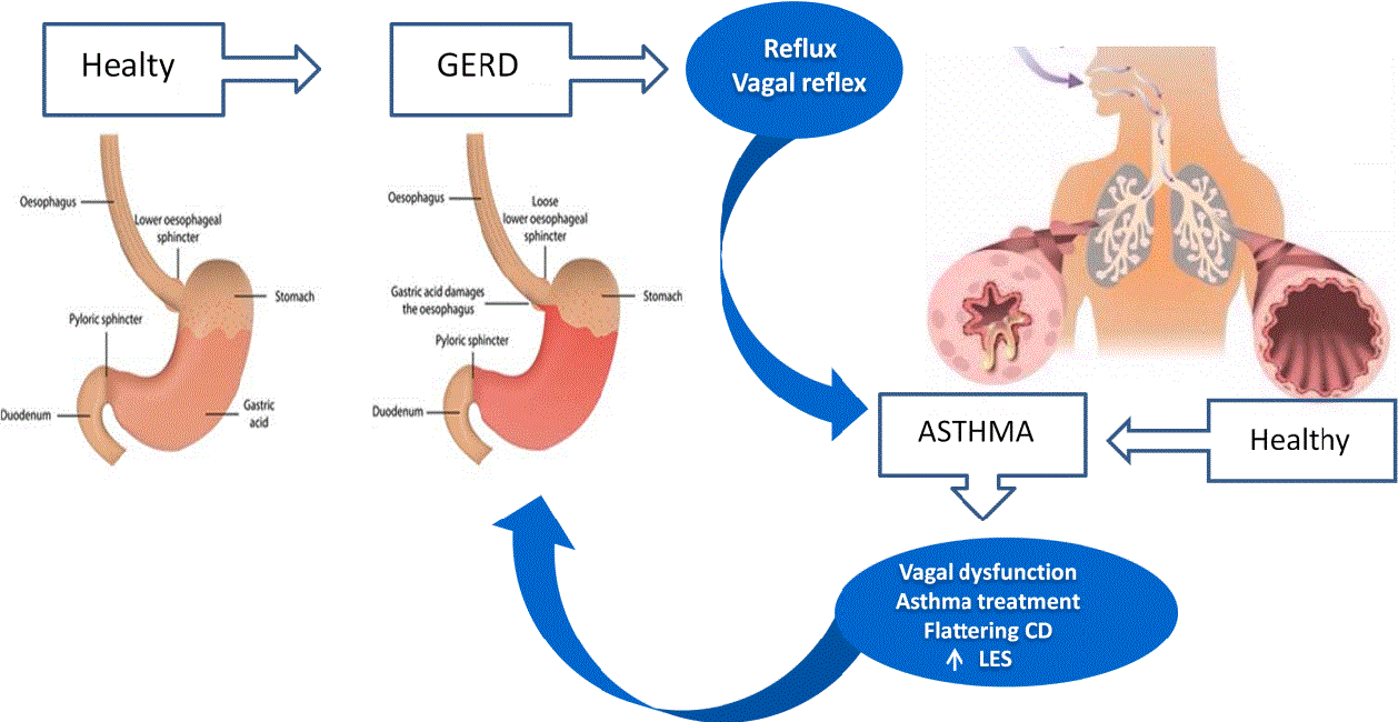 Acid Reflux And Asthma Symptoms