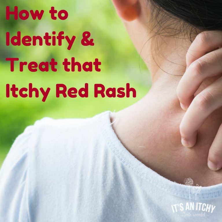 How to Identify & Treat that Itchy Red Rash
