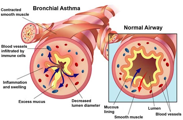 Hypnotherapy for Asthma