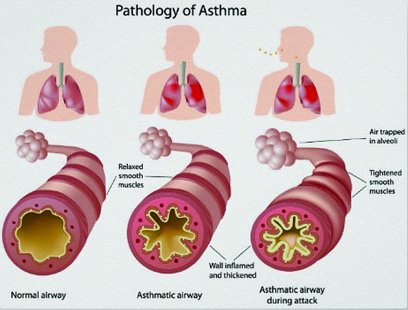 Identifying and Managing Asthma