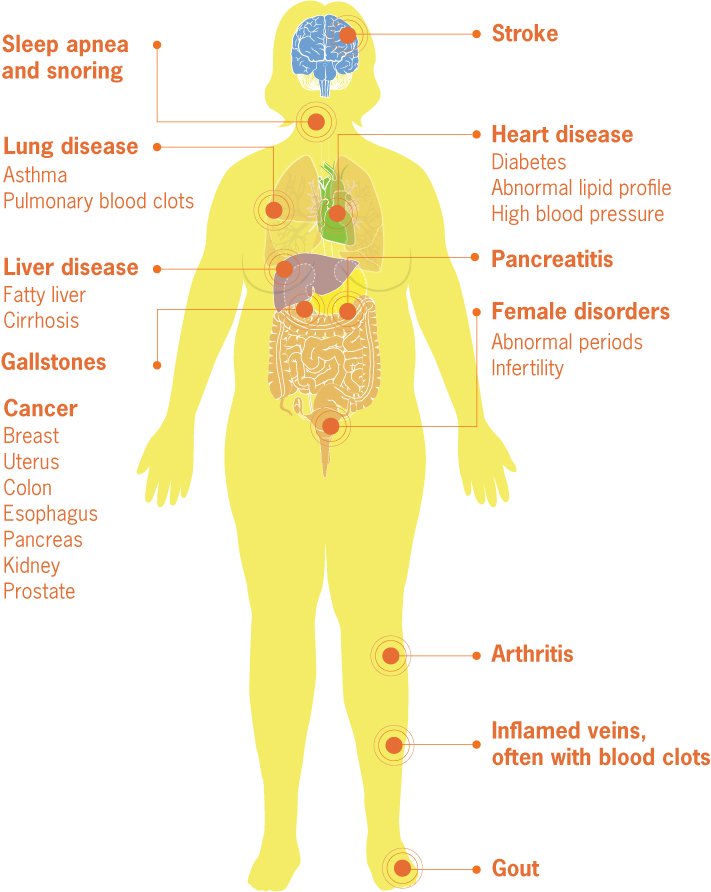 Medical Complications of Obesity