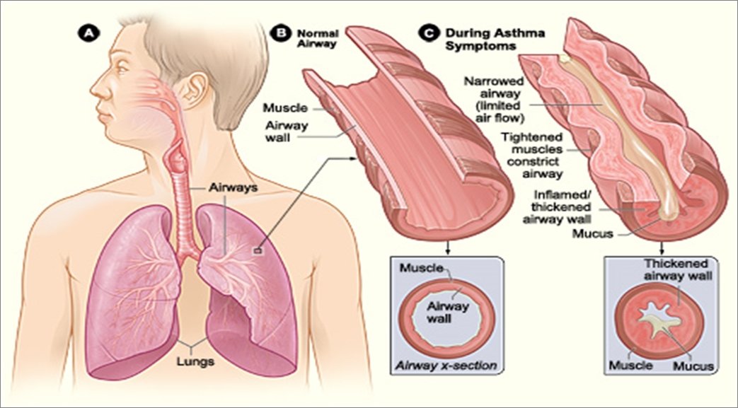 Natural asthma remedy & treatment via salt cave therapy