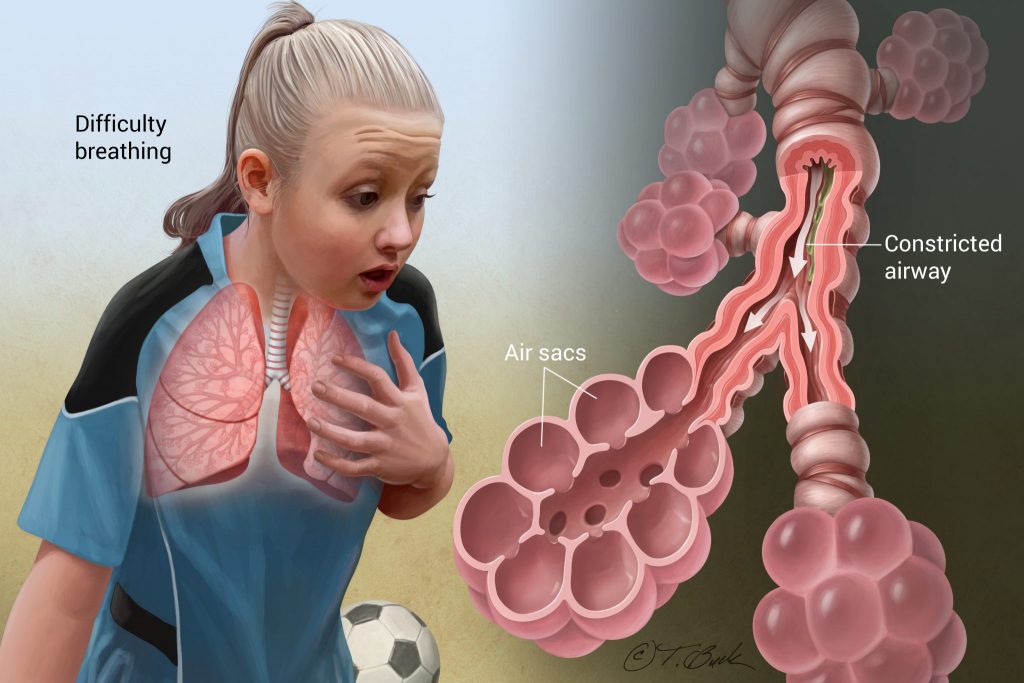 Natural Remedies for the Treatment of Asthma