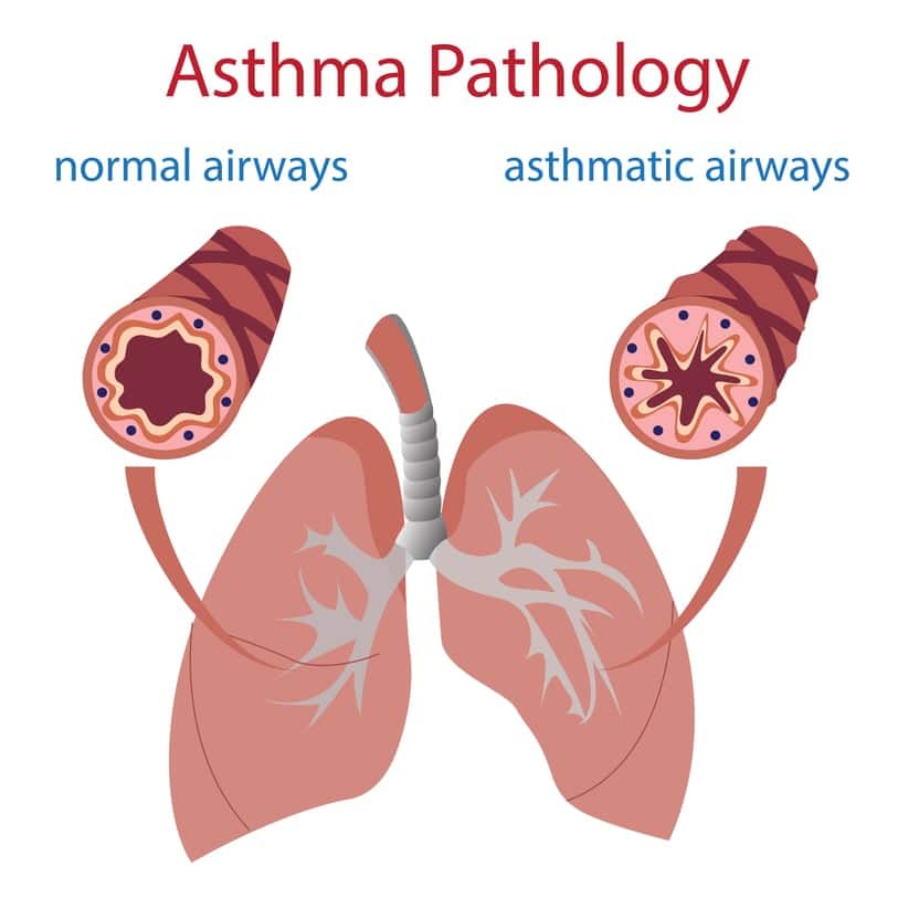 Nocturnal Asthma and Sleep Apnea