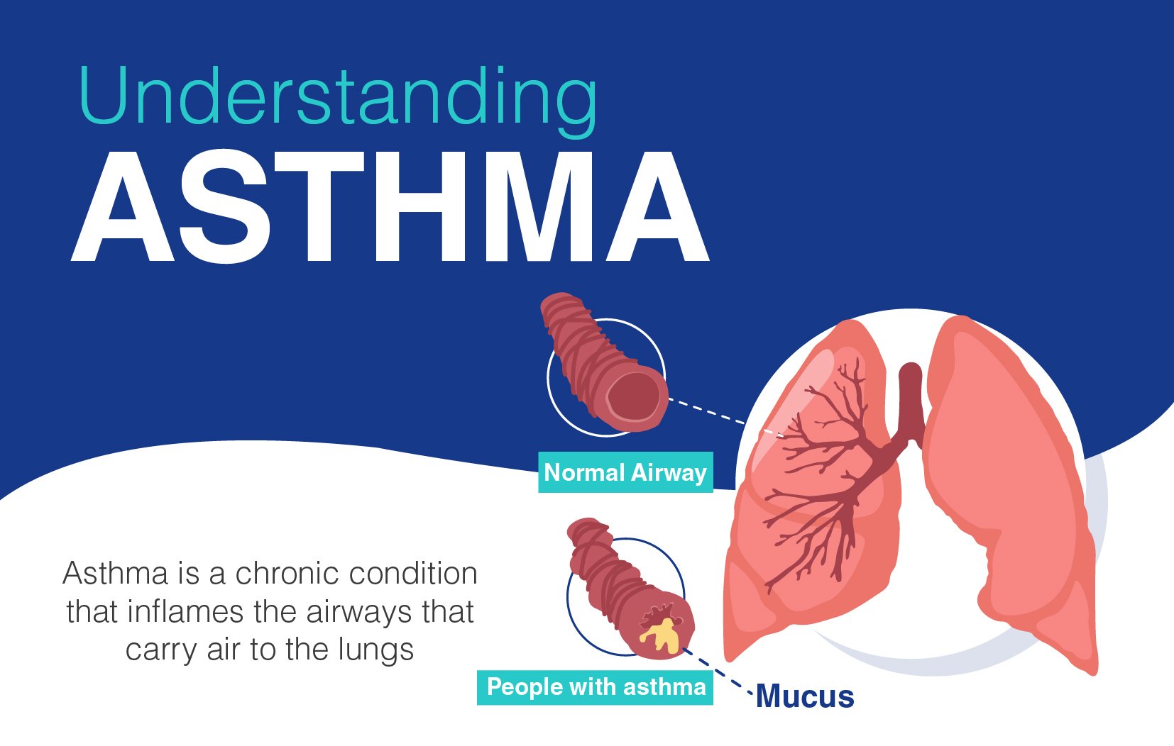Overview of Asthma: Causes, Symptoms,Types, Risk Factors and its Treatment