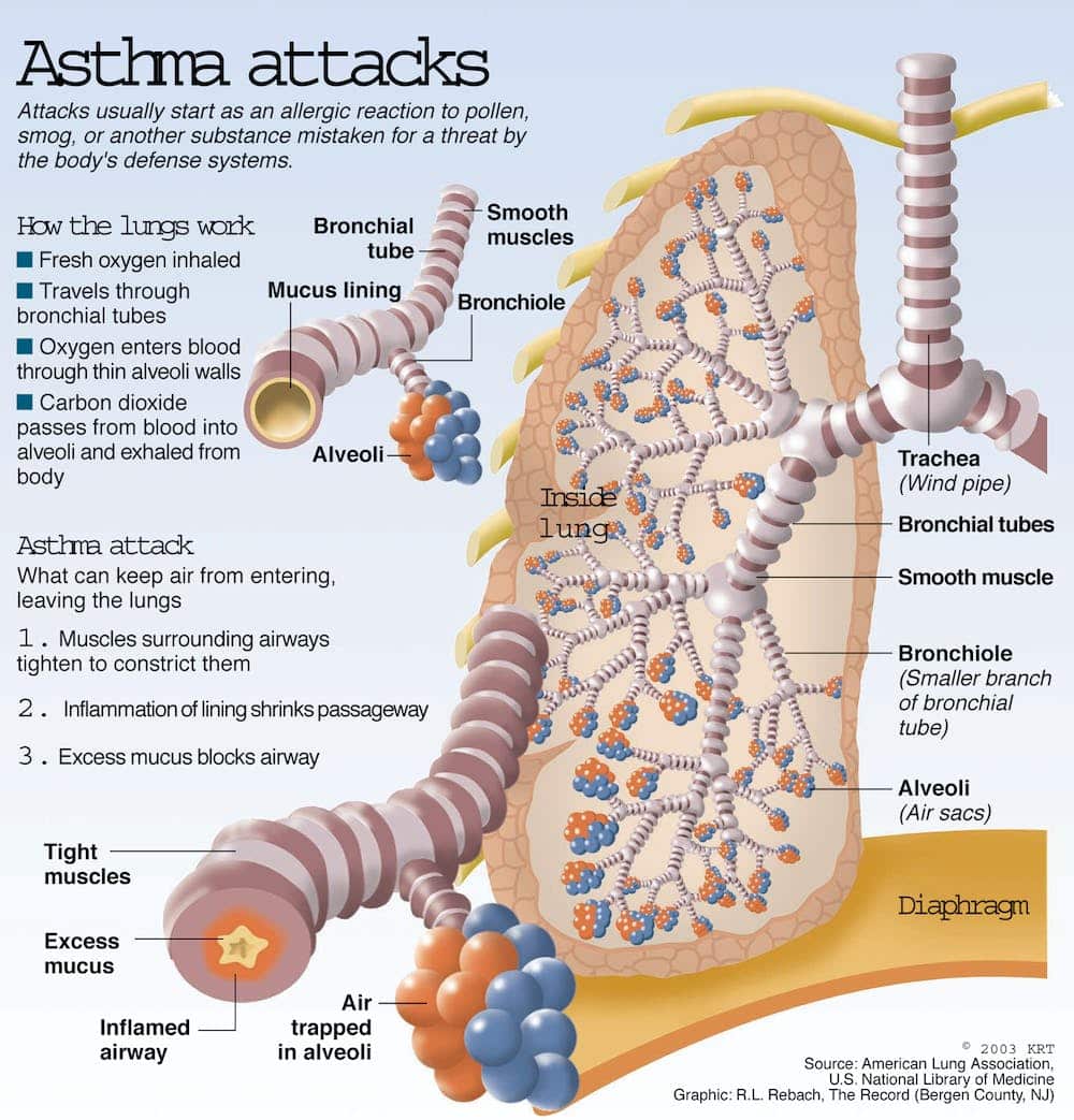 Pathophysiology Of Bronchial Asthma / Adult Emergency Medicine: Asthma ...