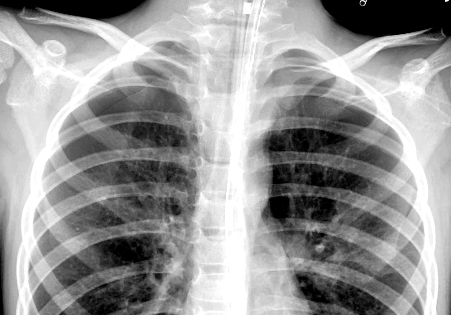 Pneumothorax (asthma)