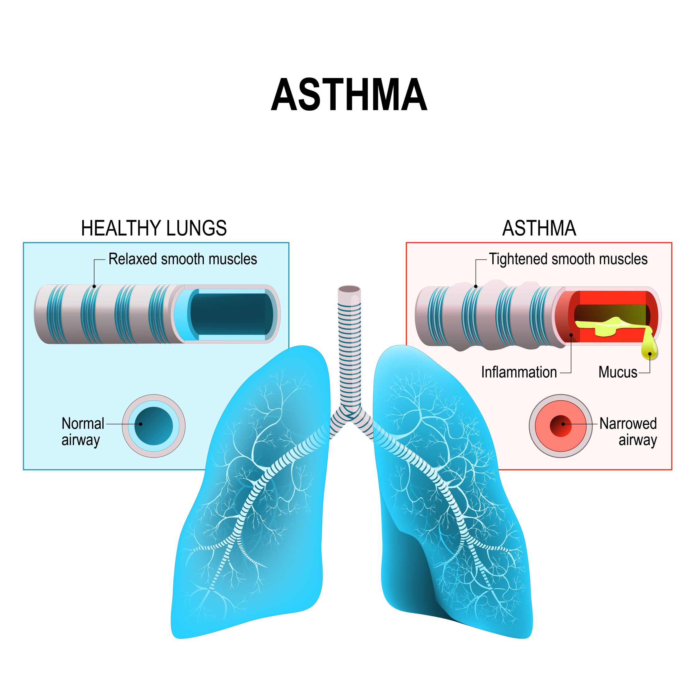 Precautions you must take if your child is suffering from asthma ...