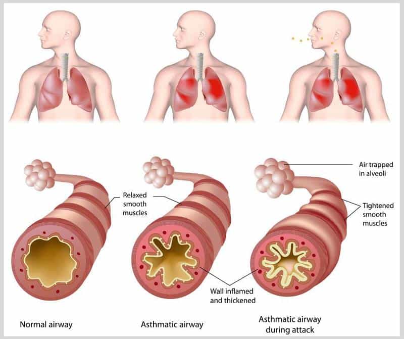 Quick and Dirty Guide to Chronic Obstructive Pulmonary Disease