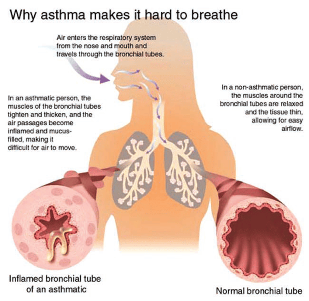Region 10 CCDC  Asthma