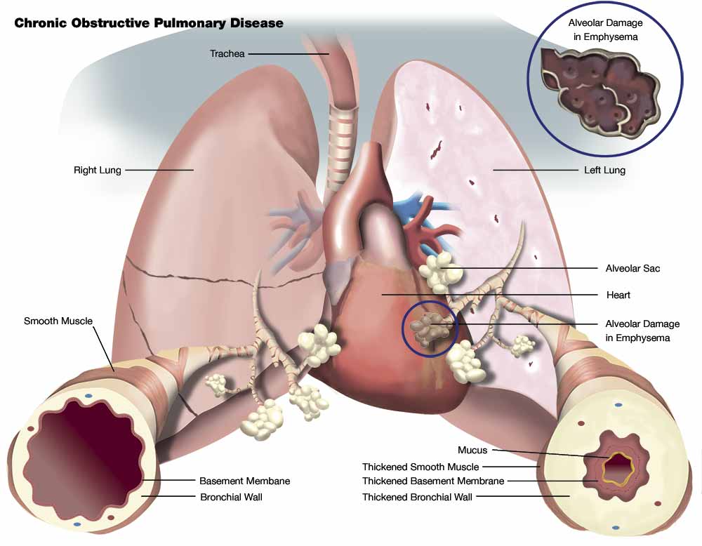 Is Asthma A Chronic Obstructive Pulmonary Disease