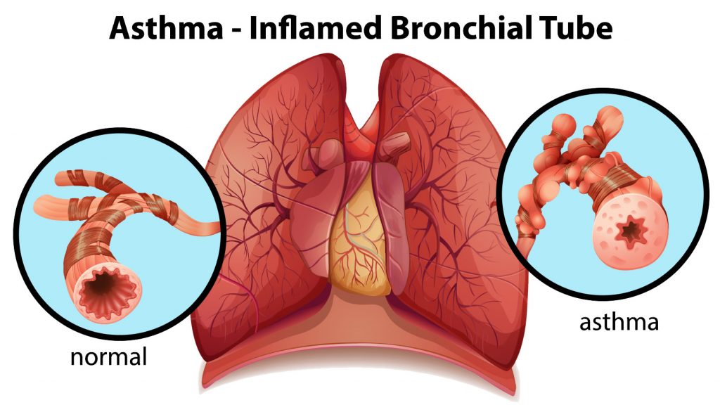 Severe Asthma in Children  Pediatric Pulmonologists in Plano