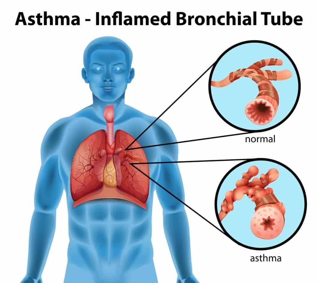 what-organs-are-affected-by-asthma-knowyourasthma