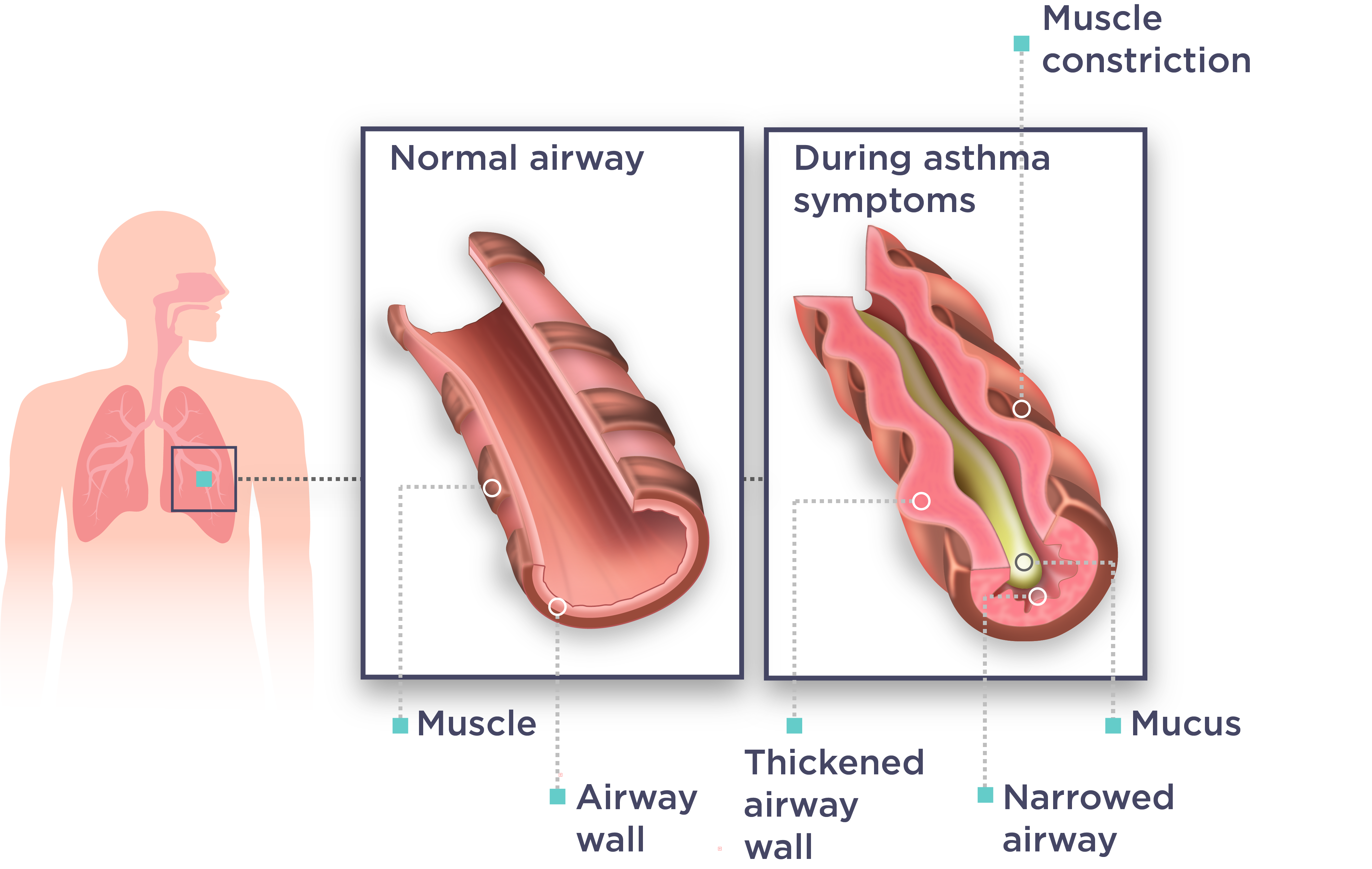 What are the asthma symptoms and how do I know if I have ...