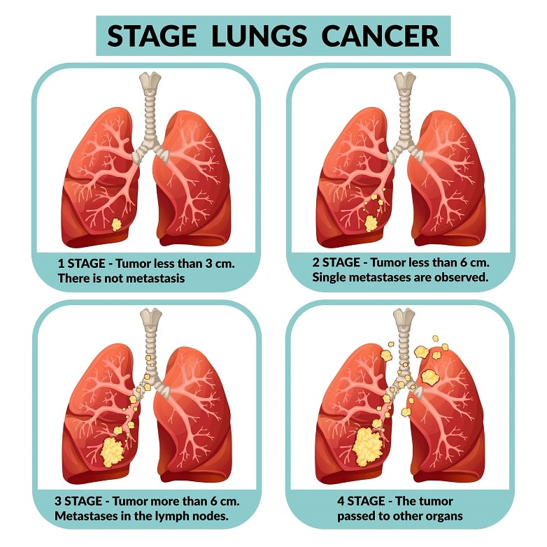 What are the Common Lung Diseases?