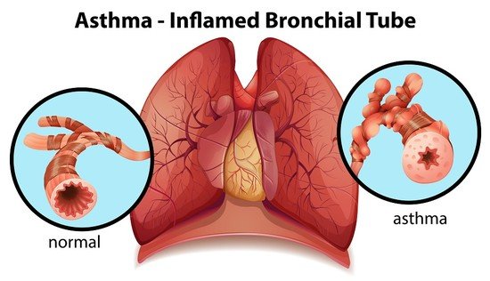 What does asthma do to the respiratory system?