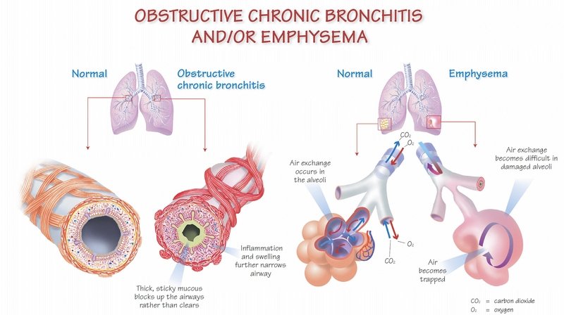 Can You Have Asthma And Copd Together