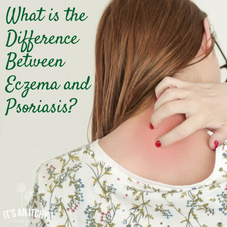What is the Difference Between Eczema and Psoriasis?