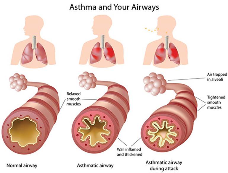 What you Need to Know about Asthma : Human N Health