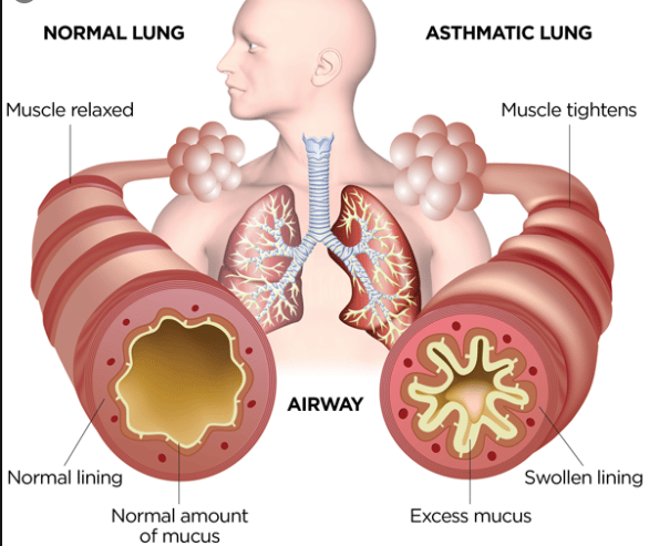 why-does-asthma-cause-wheezing-knowyourasthma