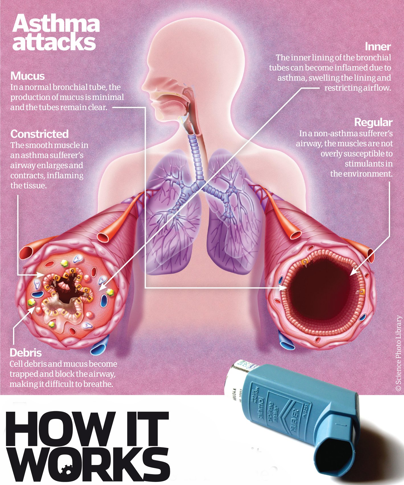 Why does asthma make it difficult to breathe?  How It Works