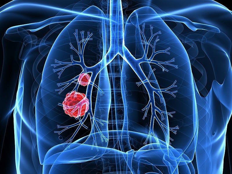 Young Lung Cancer Patients: Prime for Targeted Therapies