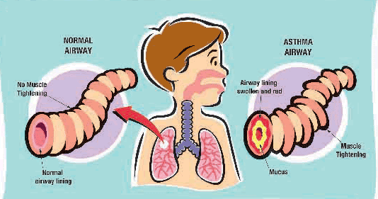 Zestzfulness: Health Tip: Recognizing Asthma in Children